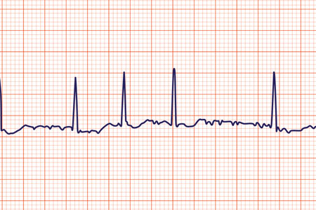 Dysrhythmia