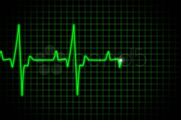 DYSRHYTHMIA For Monitor Technician DAY 2